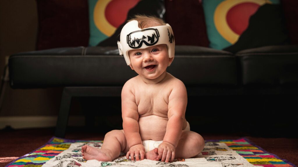 Flat Head Syndrome Treatment, What Parents Need to Know